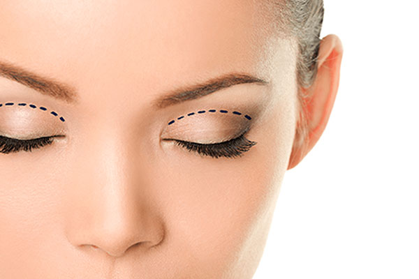 Blepharoplasty