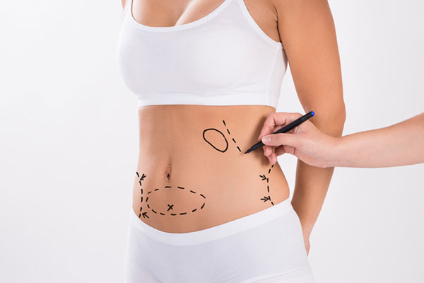 Liposuction