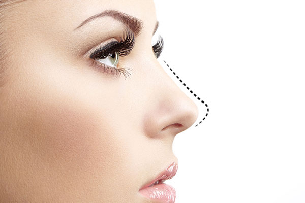 Rhinoplasty