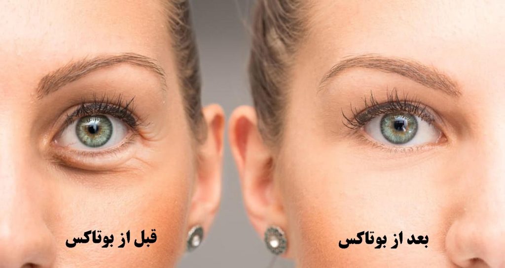 بوتاکس