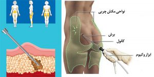 مراحل جراحی باسن برزیلی