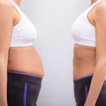 Liposuction-01
