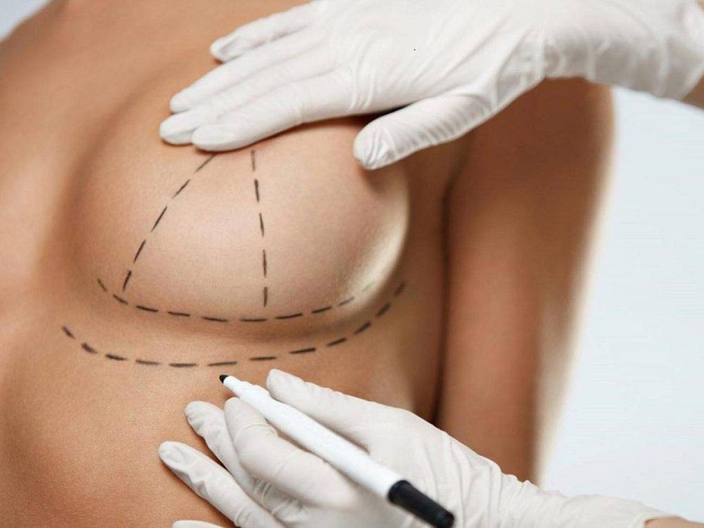 عمل لیفت سینه و عمل بالا کشیدن سینه چیست؟