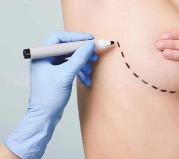 ماموپلاستی کاهنده