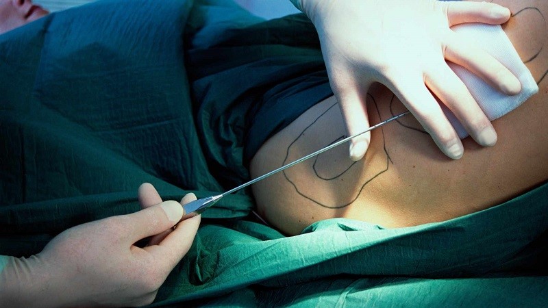 بررسی روش‌های مختلف لیپوساکشن