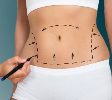 بررسی روش‌های مختلف لیپوساکشن