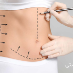 نتایج و اثرات روانی ابدومینوپلاستی