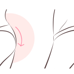 پیشنهادات پس از جراحی لیفت یاسن