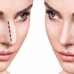 بررسی تکنیک های جدید در جراحی رینوپلاستی