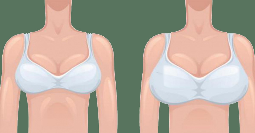 مقایسه ماموپلاستی افزایشی و کاهشی