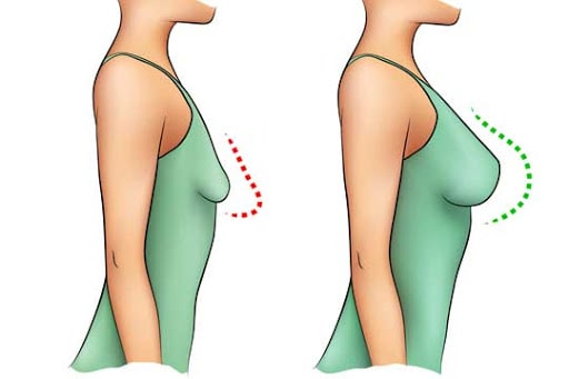 مقایسه ماموپلاستی افزایشی و کاهشی
