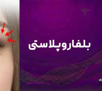 بلفاروپلاستی در قم