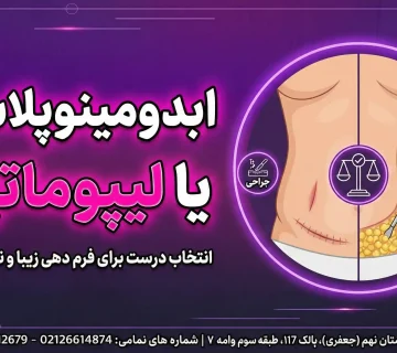 ابدومینوپلاستی یا لیپوماتیک