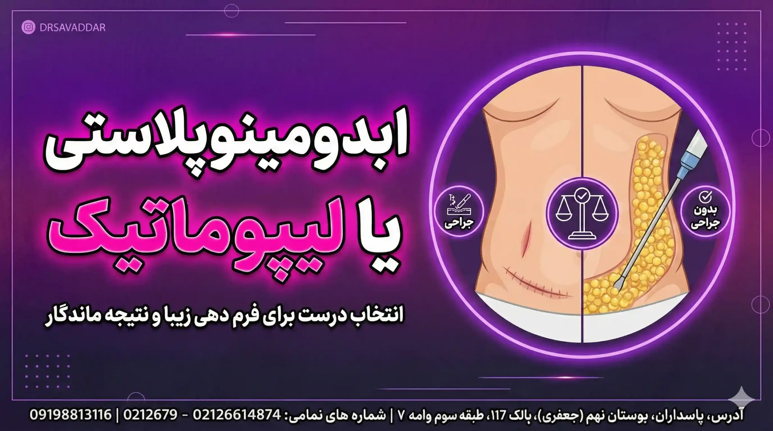 ابدومینوپلاستی یا لیپوماتیک