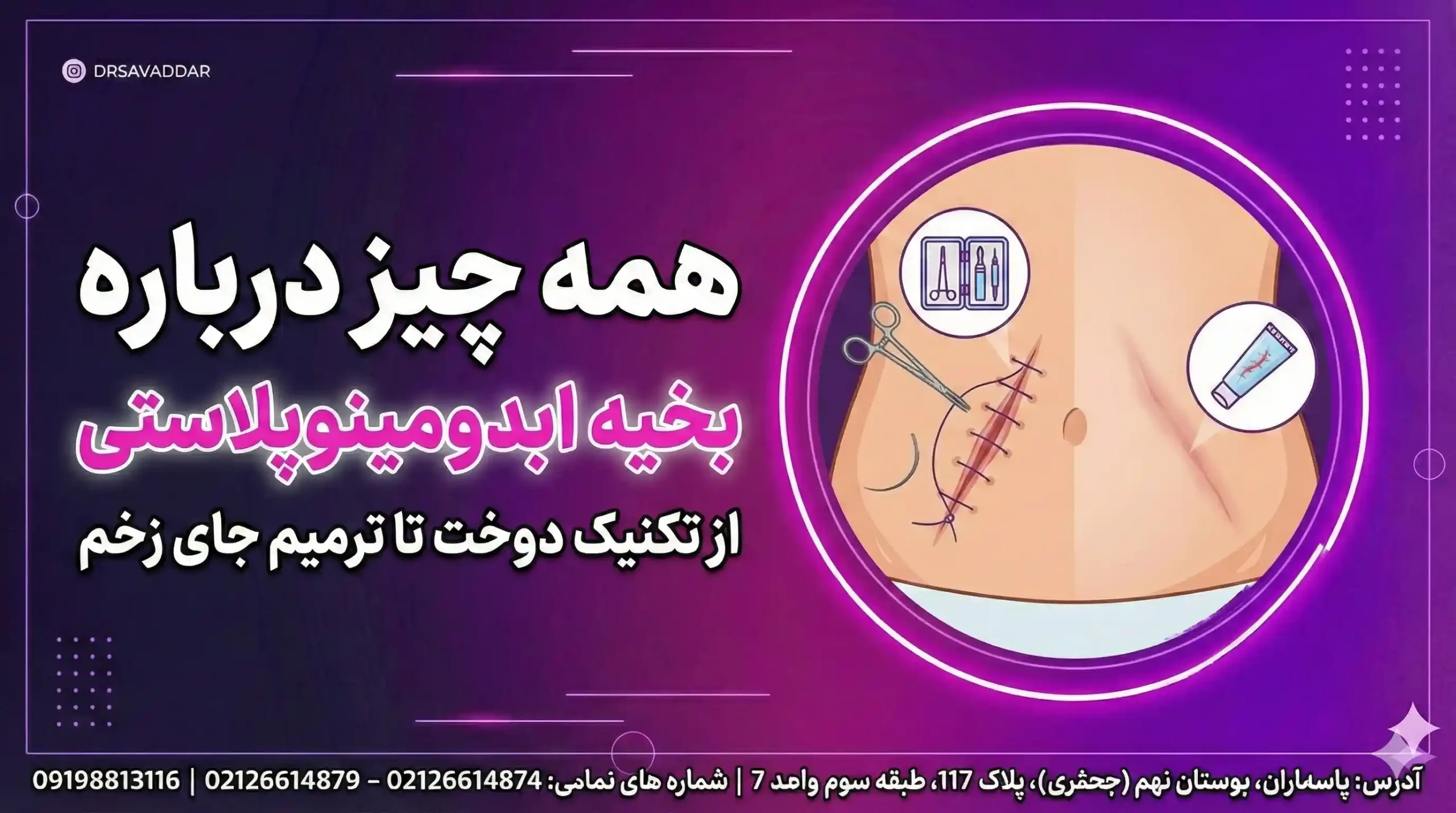 بخیه ابدومینوپلاستی