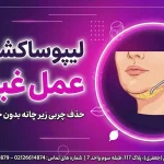 لیپوساکشن غبغب لیپوساکشن غبغب