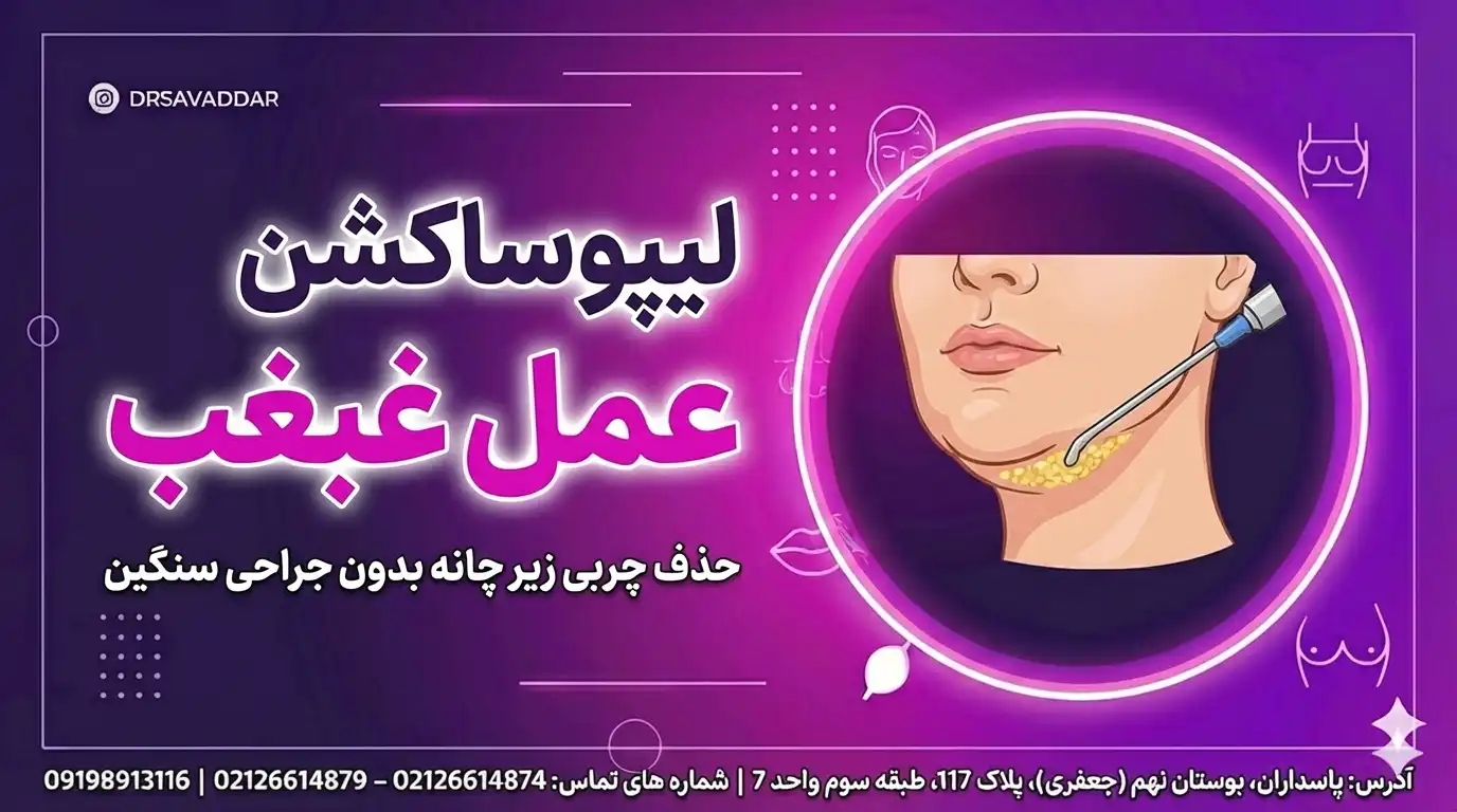 لیپوساکشن غبغب