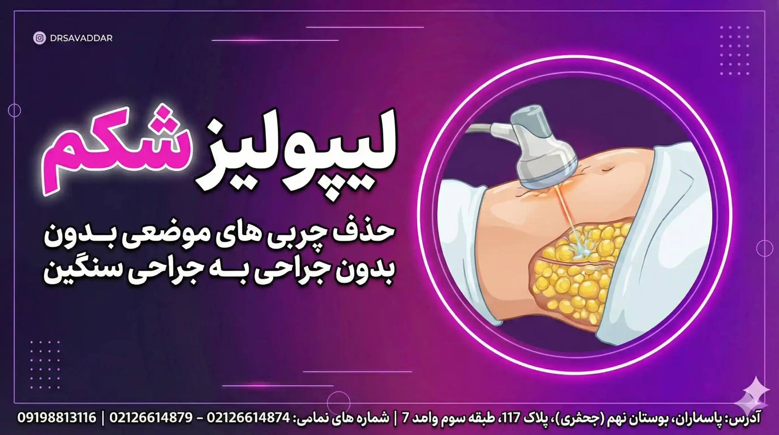 لیپولیز شکم