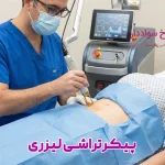 تصویر پیکرتراشی لیزری پیکرتراشی لیزری