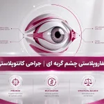 بلفاروپلاستی چشم گربه‌ای؛ هزینه، عوارض و ماندگاری