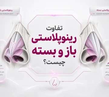 تفاوت رینوپلاستی باز و بسته؛ مزایا، معایب و انتخاب روش مناسب