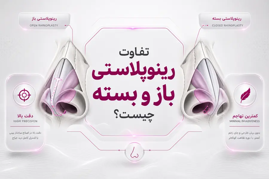 شاخص - تفاوت رینوپلاستی باز و بسته چیست؟ تفاوت رینوپلاستی باز و بسته؛ مزایا، معایب و انتخاب روش مناسب