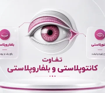 کانتوپلاستی یا بلفاروپلاستی؛ کدام روش برای تغییر فرم یا جوانسازی چشم مناسب‌تر است؟