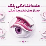 افتادگی پلک بعد از بلفاروپلاستی؛ علت چیست و چگونه درمان می‌شود؟