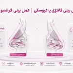 عمل بینی فانتزی و عروسکی؛ تفاوت بینی فانتزی و فرانسوی